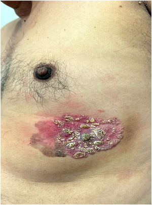General appearance of an erythematous plaque compatible with Bowen