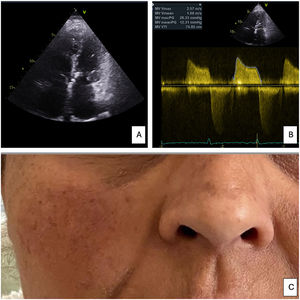 (A) Apical 4-chamber view showed typical rheumatic mitral disease such as leaflet thickening of MV and an enlarged LA. (B) Doppler evaluation showed a mean mitral gradient of 12 mmHg and a MV area of 1.2 cm2 indicating severe MS. (C) Plum-colored malar rash.