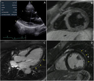 Dilated cardiomyopathy following mesalazine treatment. A, transthoracic echocardiography in parasternal long axis performed during acute presentation showing left ventricular (LV) dilation; B, T2-weighted cardiac magnetic resonance (CMR) imaging performed one-week after clinical presentation showing isointense myocardial signal, indicating the absence of edema; C and D, Subepicardial late gadolinium enhancement (LGE) in the basal-to-mid lateral wall of the LV (arrows).