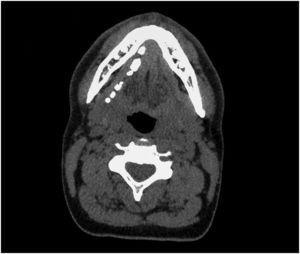 Computed tomography (CT), axial plane. Multiple sialoliths of variable size along the entire course of the right Wharton