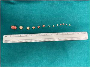 Intraoperative finding of 13 sialoliths that were successfully removed by a gland-sparing intraoral sialolithotomy.