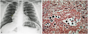 A. Initial Chest X-ray: Nodular opacity in the perihilar region and right lung base (yellow asterisk). B. Several encapsulated yeast-like structures were observed (Gomori stain, 40x). (For interpretation of the references to color in this figure legend, the reader is referred to the web version of this article.)