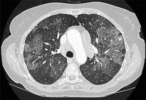 Infiltrados pulmonares bilaterales en vidrio deslustrado con patrón inflamatorio.