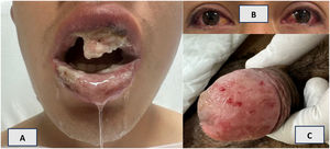 A) Lesiones del paciente: aftas en la mucosa oral, B) conjuntivitis y C) y lesiones ulcerativas en el glande.