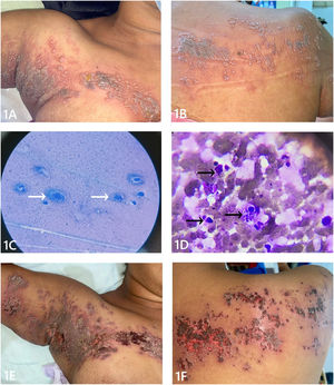 A y B) Vesículas agrupadas sobre base eritematosa extensa. Distribución dermatomérica en la región torácica superior derecha. C) Células epiteliales gigantes multinucleadas, núcleos con marginación de la cromatina, flechas blancas, Giemsa, 40×. D) Inclusiones intranucleares eosinofílicas y células inflamatorias mixtas, flechas negras, Giemsa, 100×. E y F) Placas eritematosas con costras hemáticas y mejoría sintomática de la enfermedad.