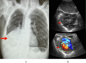 A) Radiografía de tórax, mostrando atelectasia en el pulmón derecho, flecha. B) Formación tumoral tabicada en contacto con el pericardio, así como una consolidación posiblemente, por atelectasia obstructiva (flecha).
