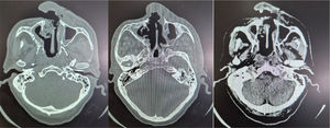 Tomografía cerebral del paciente.