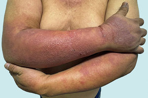 Cutaneous photoallergic reaction related to diclofenac gel use.