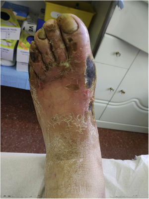 Visión anterosuperior del pie del paciente diabético con lesiones necróticas claramente visibles.