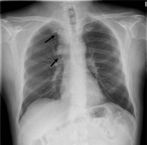 Radiografía de tórax PA. Ensanchamiento mediastínico paratraqueal derecho en relación con adenopatías (flechas). Silueta cardíaca normal. Callos de fractura en 3.°, 4.°, 5.° y 7° arcos costales izquierdos.