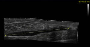Imagen hipoecogénica de 119mm en la zona posterior de la pierna correspondiente a hematoma interfascial entre sóleo y gemelo interno.