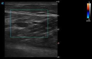 Falta de compresibilidad de la vena y ausencia de flujo sanguíneo con doppler color compatible con trombosis de la vena gemelar medial.