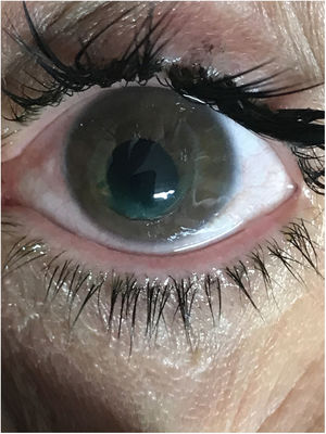 Rotura traumática del esfínter del iris (vista anterior).