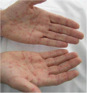 Exantema maculopapular eritematoso en las palmas de las manos.