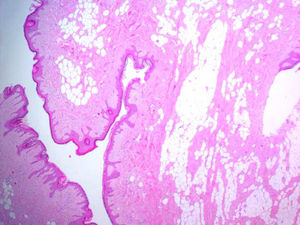 Visión microscópica que muestra focos ectópicos de adipocitos bien diferenciados no encapsulados entre los haces de colágeno en la dermis. HE (X4): Tinción con hemotoxilina-eosina.