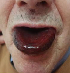 Úlcera lingual tras la ingesta de sosa cáustica.