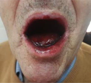 Edema y equimosis de mucosa yugal y labio inferior.