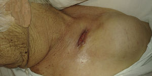 Lesión ulcerada de bordes anfractuosos y tinte eritematovioláceo.