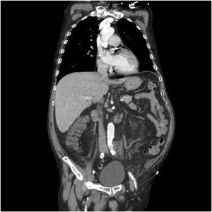 Proyección coronal de la TAC de seudoaneurisma micótico en formación.