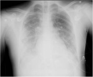 Radiografía anteroposterior torácica en la que se observan infiltrados algodonosos bilaterales de predominio en lóbulo inferior derecho.