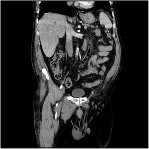 Tomografía computarizada abdominal corte coronal. Se objetiva: Aire intraluminal que se extiende desde las ramas venosas del sigma hacia todo el trayecto de la vena mesentérica inferior, con engrosamiento y realce de la pared, hasta su confluencia al eje esplenoportal. Aire en radicales portales derechos e izquierdos de probable origen ascendente, secundarios al proceso previamente descrito.