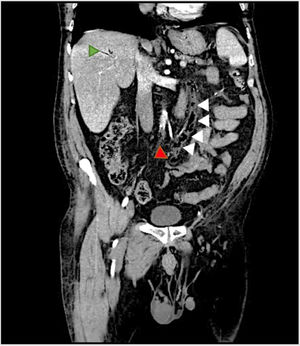Tomografía computarizada abdominal corte coronal con flechas indicativas. Se objetiva: Aire intraluminal que se extiende desde las ramas venosas del sigma hacia todo el trayecto de la vena mesentérica inferior, con engrosamiento y realce de la pared, hasta su confluencia al eje esplenoportal. Aire en radicales portales derechos e izquierdos de probable origen ascendente, secundarios al proceso previamente descrito.