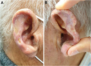 Imagen clínica. A) Aspecto fibrótico de la piel y ulceración focal. B) Rigidez del cartílago auricular con preservación del lóbulo.