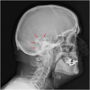 Radiografía de cráneo que demuestra opacificación de las estructuras cartilaginosas del pabellón auricular (flechas).