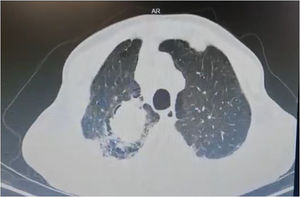 Tomografía axial computarizada (TAC) tóraco-abdominal: masa de apariencia neoplásica descrita en el lóbulo superior derecho con compromiso ganglionar mediastinal e hiliar bilateral.