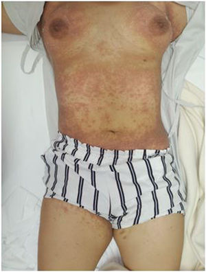 Múltiples pápulas queratósicas, confluentes y predominantes en el abdomen, el tórax superior, la espalda y en menor medida en la región proximal de los miembros inferiores, de color eritematoparduzco.