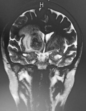 Tomografía axial computarizada de cráneo que muestra la lesión con efecto de masa de predominio derecho en la región ganglio basal izquierda, se observan las lesiones en el anillo hacia la zona central de las lesiones con aspecto edematoso y digitiforme.