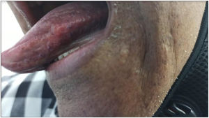 Borde lateral derecho de la lengua que tiene máculas hiperpigmentadas de color marrón oscuro.