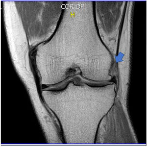Resonancia magnética nuclear de la rodilla izquierda. La flecha señaliza la lesión parcial grado II del ligamento colateral medial con calcificación de la inserción femoral.