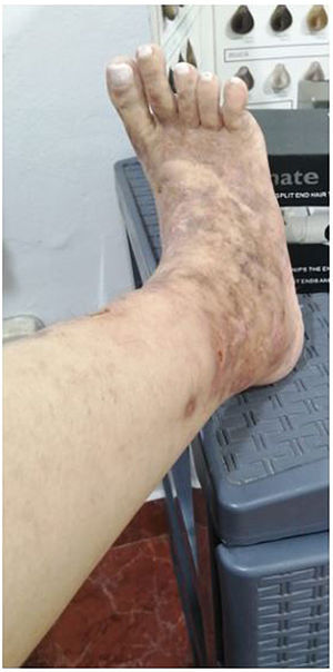 Lesiones cicatriciales no ulceradas en el pie.