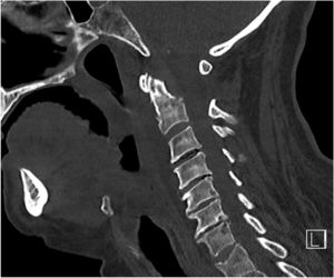 Fractura de la base de odontoides en nuestra paciente.