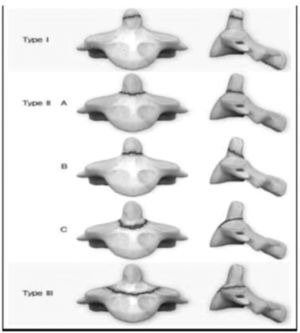 Tipos de fracturas de los odontoides. Fuente: Cho et al.[3].