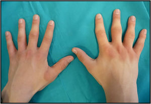 Piel marronácea, engrosada y de aspecto liquenificado en el dorso de las articulaciones MCF de ambas manos.
