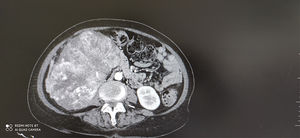 TAC urológico: imagen de aspecto neoformativo de 15x12x15 cm, con infiltración de todo el parénquima renal.