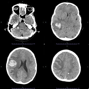 Imágenes de tomografía. Cortes axiales simples. Se observan 4 lesiones intraparenquimatosas hemorrágicas (hiperdensas) de localización occipital izquierda de 8 mm, cerebelosa derecha de 11 mm, parietooccipital derecha de 36 mm y temporal inferior de 38 mm, con edema perilesional y efecto masa.