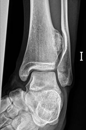 Radiografía del pie izquierdo en proyección oblicua.