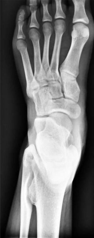 Radiografía del pie izquierdo en proyección anteroposterior.