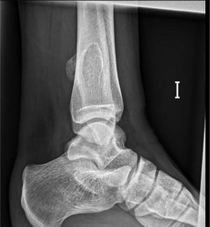 Radiografía del pie izquierdo en proyección lateral.