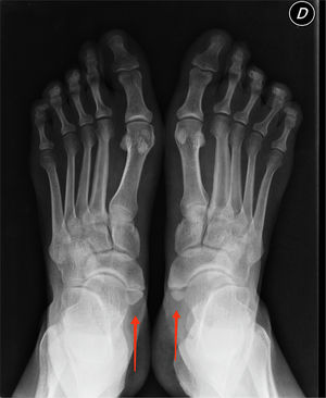 Radiografía de ambos pies, con presencia de escafoides accesorio (os navicular) bilateral.