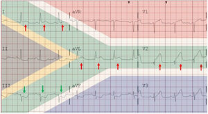 Electrocardiograma con patrón de la bandera sudafricana. Elevación ST en I, aVL y V2 (flechas rojas). Descenso ST en III (flechas verdes).