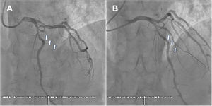 Angiografía coronaria. A) Oclusión aguda trombótica a nivel de ramo diagonal (flechas). B) Recuperación de flujo tras angioplastia e implante de stent recubierto (flechas).