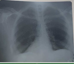 Chest X-ray demonstrating dextrocardia with the heart located on the right side, accompanied by pulmonary infiltration in the bilateral lower lobes.