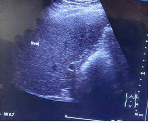 Ultrasound findings confirming the liver