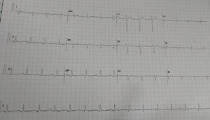 ECG findings demonstrating R waves in aVR and S waves in V6 and V5, accompanied by right axis deviation.