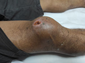 Rodilla afectada previa a la intervención.