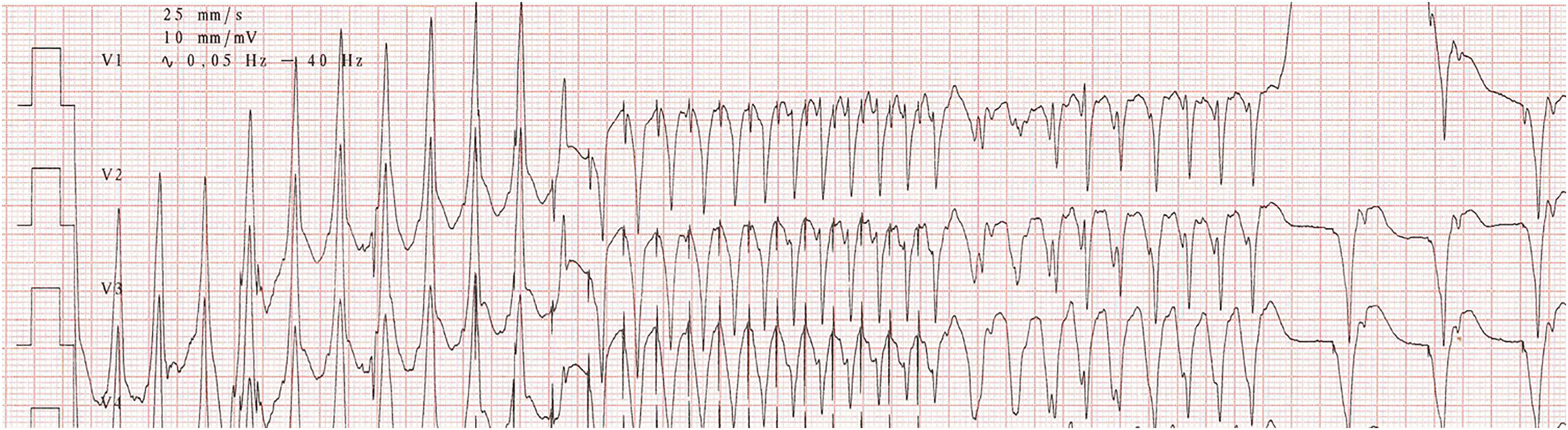Advanced pacing algorithms resembling device malfunction: A ...